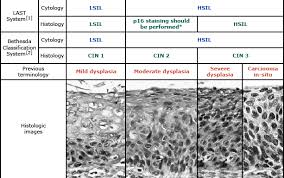 Associated with for bethesda categories iii to vi, especially iii and iv (niftp constitutes a substantial proportion of the malignancies hidden in these categories). Cin Terminology And Histology Uptodate