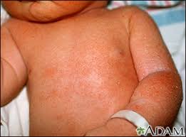 Mottled skin is also called livedo reticularis and it thought to be connected to vascular. Skin Findings In Newborns Information Mount Sinai New York