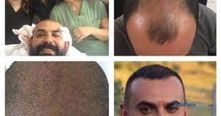 Dunya Sac Ekim Danismanligi Dunya Sac Ekim Danismanligi Turkiye De Sac Ekim Merkezleri Mersin Sac Ekim Mersinde Sac Ekim Merkezleri Mersi Sac Ince Saclar Dunya