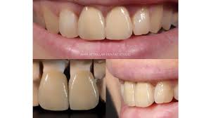 According to an estimate made by costhelper, the price range of dental crowns per tooth today can be as follows: Gold Crown Tooth Cost And Comparison To Porcelain