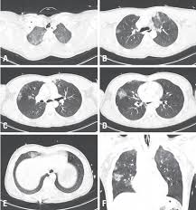 Image result for Pulmonary Contusion