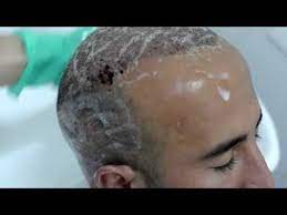 First Hair Wash After The Hair Transplant Youtube Hair Transplant One Hair Washing Hair