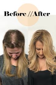 New Hope For Thinning Hair Clients Hair Thinning On Top Why Hair Loss Normal Hair Loss
