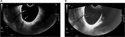 Insert nuvaring into your vagina. The Vaginal Ring Expelled Or Misplaced Bhaduri 2009 Journal Of Ultrasound In Medicine Wiley Online Library