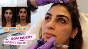 My Botox Filler Experience Lisa Homsy Youtube Lisa khanna ve diğer tanıdıklarınla iletişim kurmak için facebook'a katıl. my botox filler experience lisa homsy