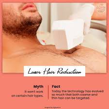 Advanced laser hair removal is owned and operated by sheila, a certified laser technician since 2003, using methods that are recommended by physicians across canada. Benefits Of Laser Hair Removal
