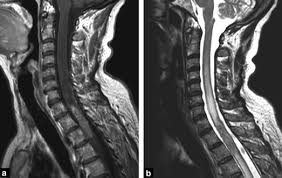 Some common signs of metastatic cancer include The Different Faces Of Central Nervous System Metastases Sciencedirect
