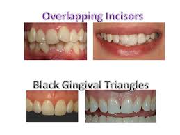 Black And White Braces For Teeth Early Correction Of Overlapping Incisors Is Important To Minimize The Chances Of Developing Black Gingival Triangles After Teeth Are Straighten Due To The Gum