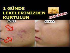 1 Gunde Lekelerinizden Kurtulun Leke Giderici Altin Maske Tarifi Natural Beauty Youtube Skin Care Dogal Cilt Bakimi Cilt Bakimi