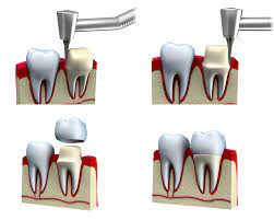 Is My Aching Crown Tooth Decay Or Something Else Gary Nack Dds