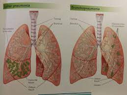 Learn vocabulary, terms and more with flashcards, games and lung parenchyma. Pneumonia Is An Acute Infection Of The Lung Parenchyma That