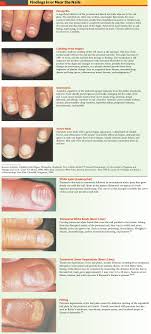 findings in or near nails paronychia a