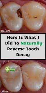Rebuild Your Teeth Gum Decay Free Tooth Decay Remedies Heal Cavities Cavity Remedy