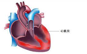Carditis] 心肌的炎症, 即指心肌中有局限或弥漫性的急性、 亚急性或慢性炎性变化, 病因包括细菌、 病毒与风湿病三种. å¦‚ä½•å°½æ—©è¯†åˆ«çˆ†å'æ€§å¿ƒè‚Œç‚Ž æ¯æ—¥å¤´æ¡