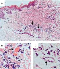 Sepsis is a serious infection usually caused when bacteria make toxins that cause the immune system to attack the body's own organs and sepsis is a medical emergency that needs treatment right away. Skin Biopsy Specimen From A Patient With Meningococcal Sepsis A Biopsy Download Scientific Diagram