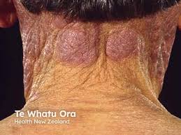 Image result for Photodermatitis