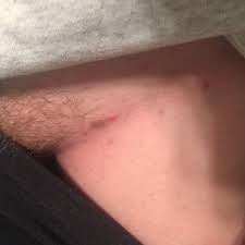 You may be more likely to get. Ingrown Hair Or Varicose Vein In The Crease Between My Leg And Pubis It S Just Weirding Me Out That It S So Long And Wiry Glow Community