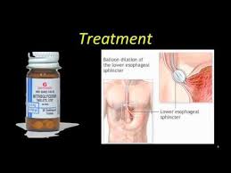Esophageal Spasm Esophageal Spasm Health And Wellness News Health