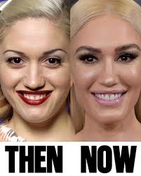 Gwen Stefani: THEN vs. NOW 🖤🤍 She says she's just “aging gracefully.”  Grace must be a board-certified cosmetic surgeon.