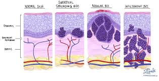 basal cell carcinoma is more common in patients with fair skin, especially after prolonged sun exposure, frequent tanning, and other risk factors. Basal Cell Carcinoma Of The Skin Mypathologyreport Ca
