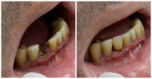 Image result for Tooth Extraction