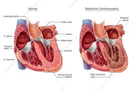 Image result for Restrictive Cardiomyopathy