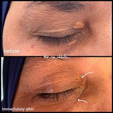 Image result for xanthelasma of eyelid