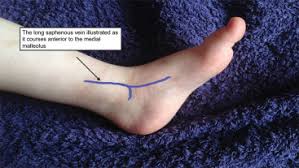 Image result for Difficult Intravenous Access in Children