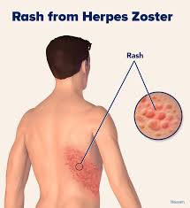 Image result for herpes zoster