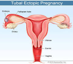 Ectopic Pregnancy Signs Symptoms Causes Test