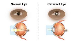 Image result for Cataract Extraction