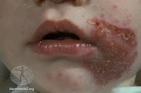 Image result for yellow scabs on the face in children