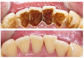 The answer to that question is a resounding yes, as there are lots of stain removing tips and products you can. Stain Removal In Coseley West Midlands Roseville Dental Practice