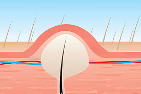 Image result for Pilonidal Cyst