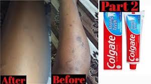 Do you find dark spots to be a dampener when you wish to wear an outfit that would help you flaunt your legs? How To Get Rid Of Spots On Legs