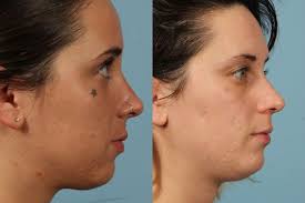 I had it redone a couple years ago and it's so much better. Heights Laser Tattoo Removal Before And After Gallery