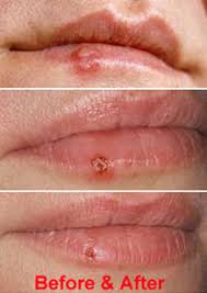 Cold sores are blistery, crusty sores that usually form around your lips. Cold Sore Stages Causes Symptoms Is It Contagious