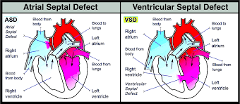 atrial septal defect vs ventricular septal defect both