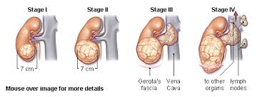 A cancerous or malignant tumor can spread (metastasize) to other tissues and vital organs. Renal Cancer Physiopedia
