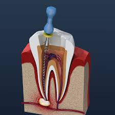 Root Canal Treatment-RCT - Grande Prairie Family Dental