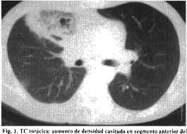 Mucormycosis mainly affects people who have health problems or take medicines that lower the body's ability to fight germs. Mucormicosis Pulmonar Presentacion De Un Caso Y Revision Bibliografica Semantic Scholar