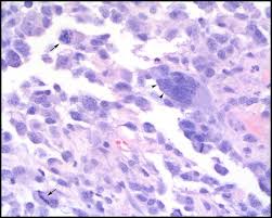 .mesothelioma and spindle cell/pleomorphic (sarcomatoid) carcinomas of the lung: Conference 12 2007 Case 2 20080102