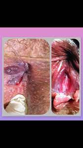 Fissura Anal Cronica Pomada Ou Cirurgia Ilustrado Com Artigo Com Fotos Canal De Videos E Com Links Para Blogs Das Doencas Proctologicas Tratadas Com Laser E Atlas Com Fotos Falando Sobre Fissura