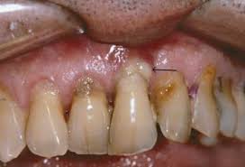 Periodontitis treatments and natural home remedies for periodontal disease. Periodontitis Mouth And Dental Disorders Msd Manual Consumer Version