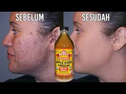 Manfaat cuka apel telah dikenal masyarakat luas untuk kesehatan, termasuk untuk menurunkan berat badan. Jerawat Hilang Menggunakan Cuka Apel Kaskus