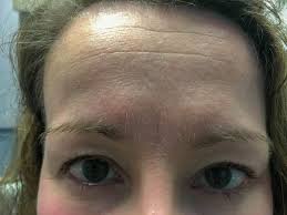 On average, botox lasts anywhere from three to five months. Botox Aftercare What To Expect After Botox First Time Botox