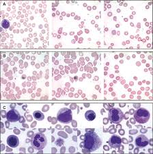 Tests like a blood smear, white blood cell differential, and reticulocyte count can often help assess anemia after an abnormal cbc. Significance Of Teardrop Cells In Peripheral Blood Smears