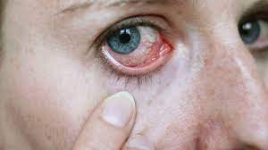 Hinter Roten Augen Kann Uveitis Stecken