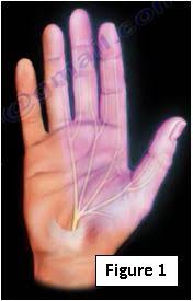 How should i relieve a broken pinky on my hand? Common Hand And Finger Problems Huffpost