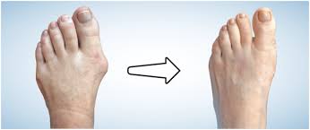 Surgery may be necessary to remove. Cosmetic Foot Surgery London Foot And Ankle Surgery
